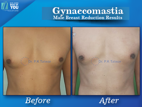 Gynaecomastia before after image